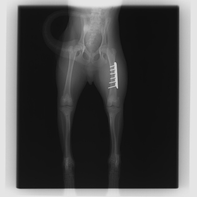 大腿骨(ふとももの骨)の骨折　　手術後